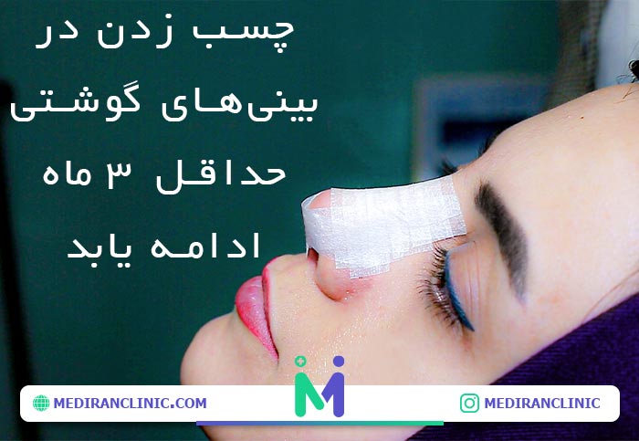 مدت زمان چسب زدن در بینی های گوشتی