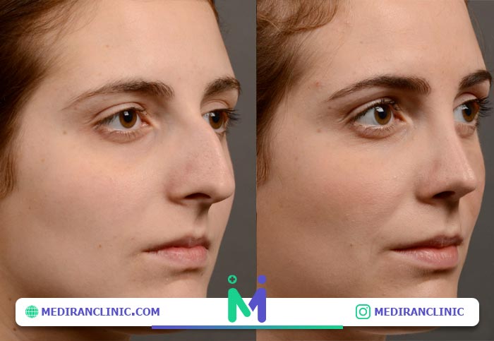 قبل و بعد بینی استخوانی