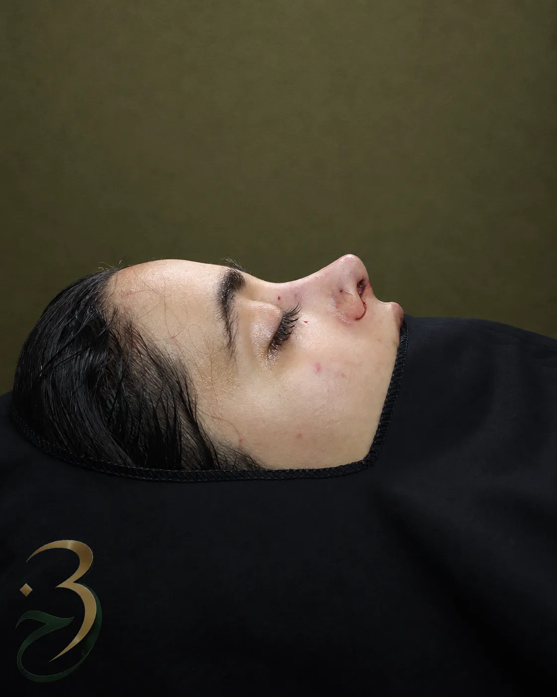 رینوپلاستی — بعد