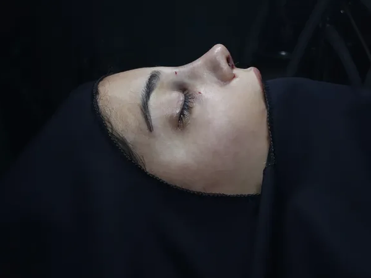 رینوپلاستی (جراحی بینی) — قبل
