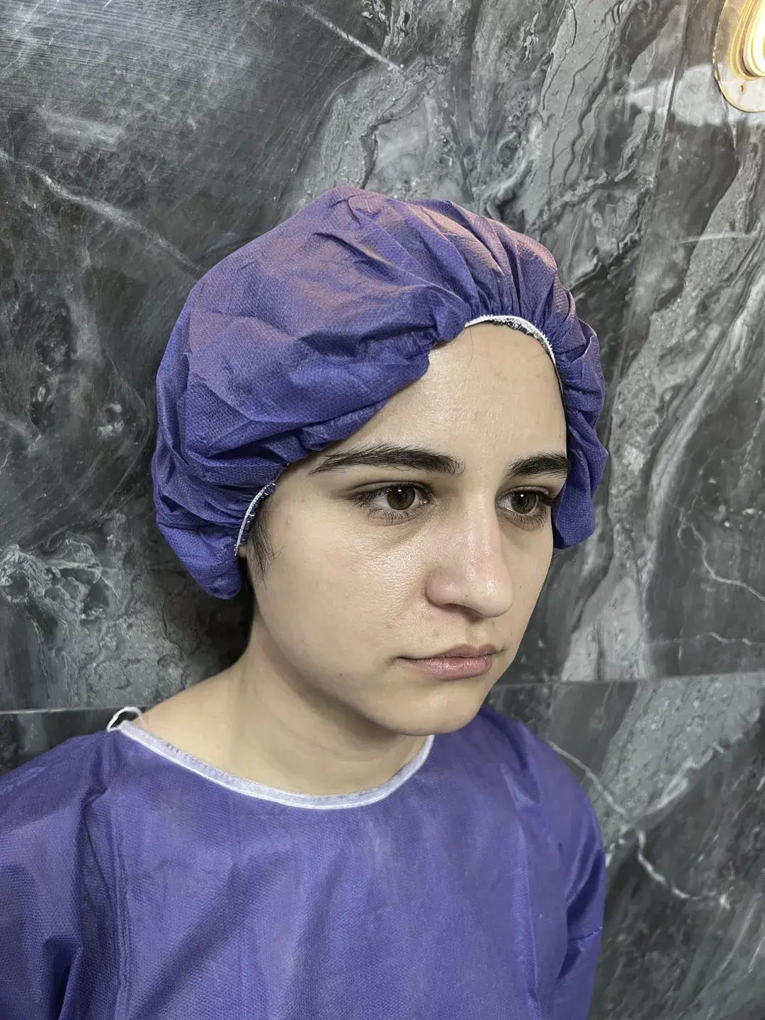 رینوپلاستی (جراحی بینی) — بعد