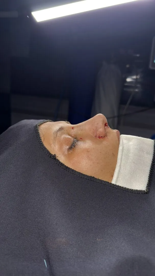رینوپلاستی (جراحی بینی) — بعد