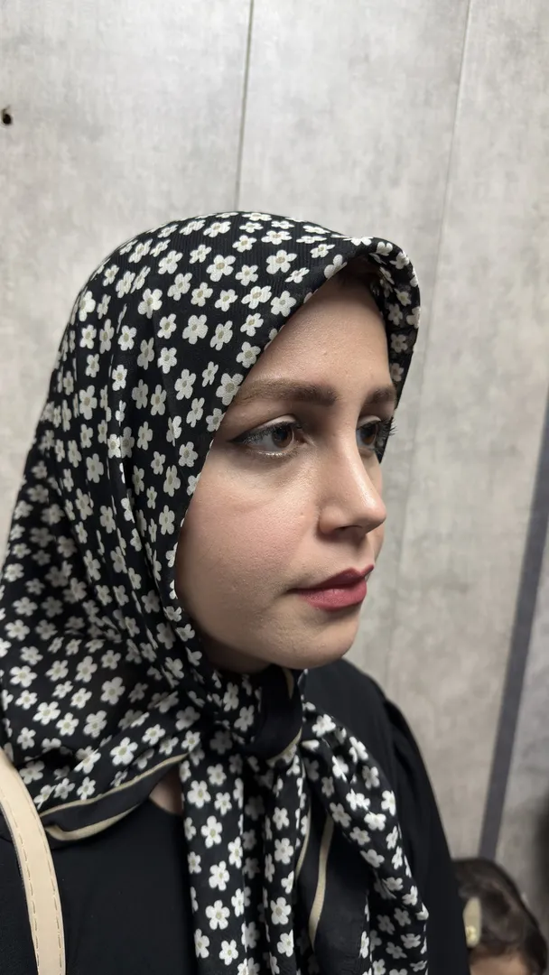 رینوپلاستی (جراحی بینی) — بعد