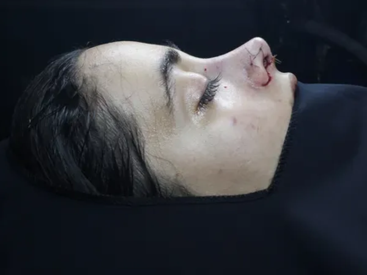رینوپلاستی (جراحی بینی) — قبل