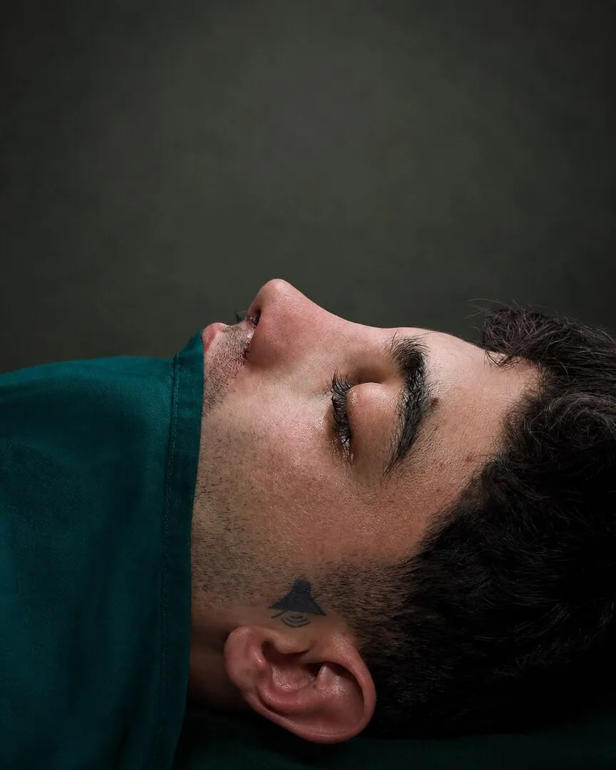 رینوپلاستی (جراحی بینی) — بعد