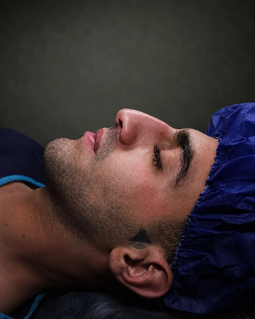 رینوپلاستی (جراحی بینی) — قبل