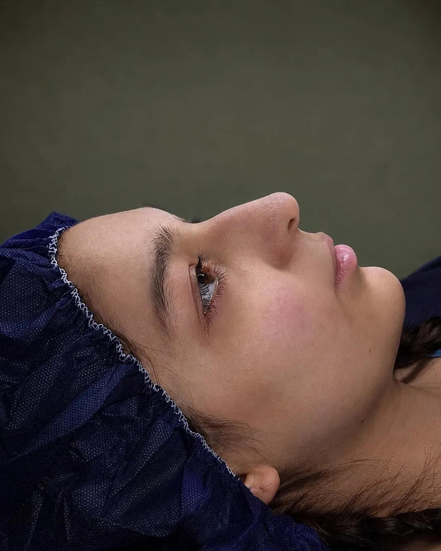رینوپلاستی (جراحی بینی) — بعد