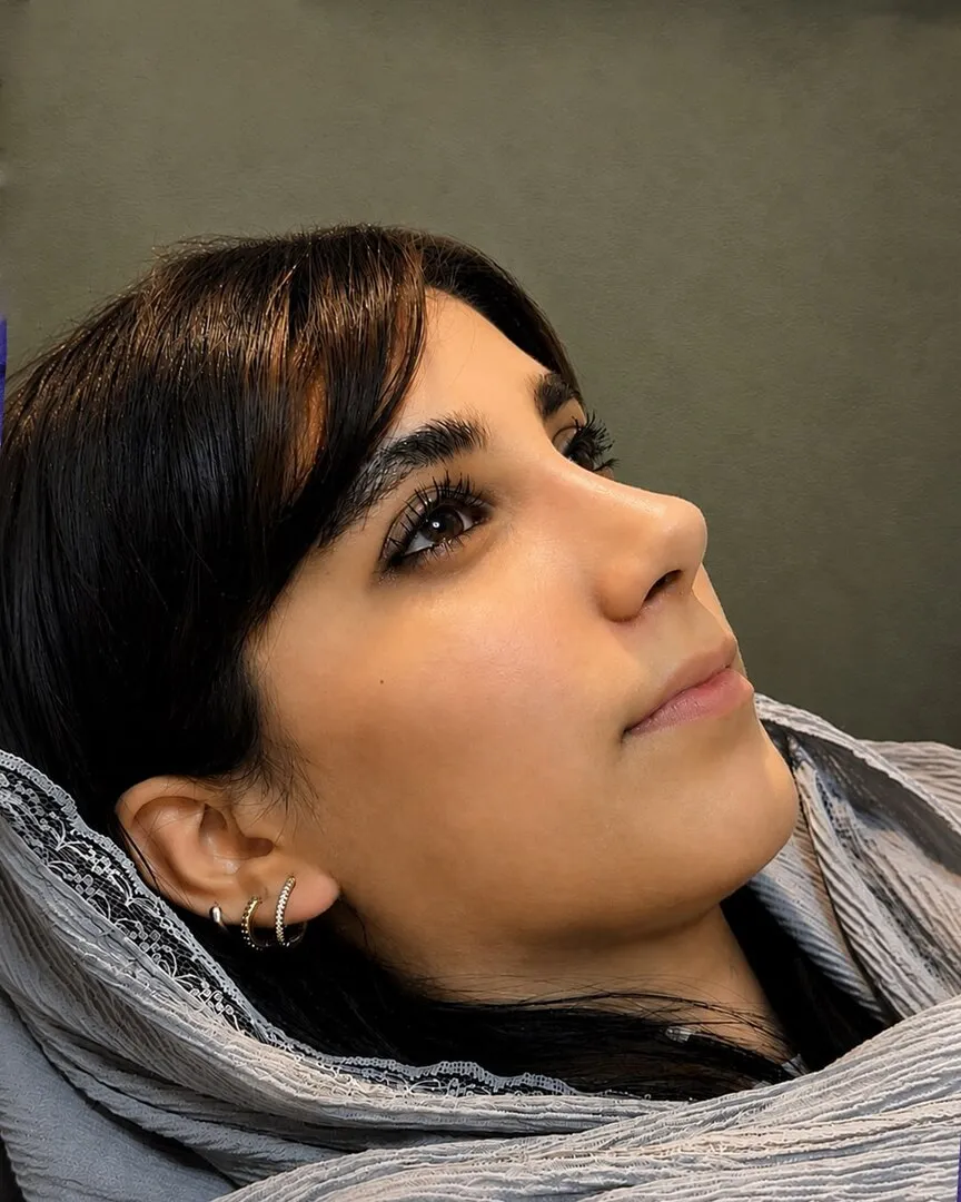 رینوپلاستی (جراحی بینی) — بعد