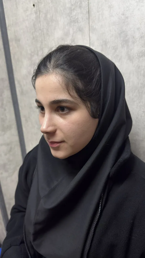 رینوپلاستی (جراحی بینی) — قبل