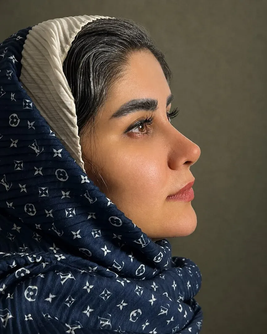 رینوپلاستی (جراحی بینی) — بعد