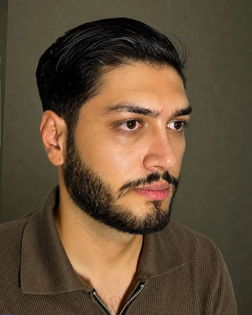رینوپلاستی (جراحی بینی) — بعد