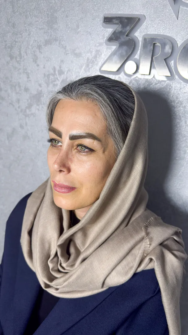 رینوپلاستی (جراحی بینی) — قبل
