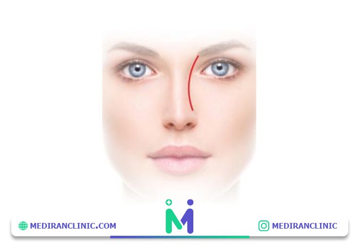 زیبایی شناسی چهره بر اساس ابرو و بینی