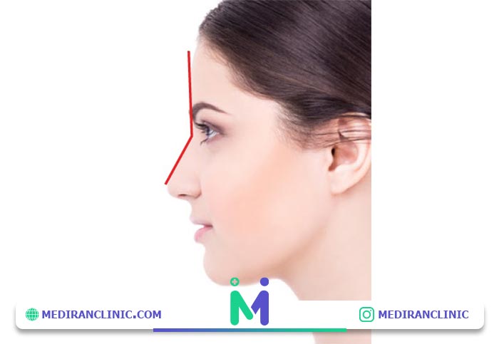 زاویه بینی و پیشانی در زیبایی شناسی عمل بینی