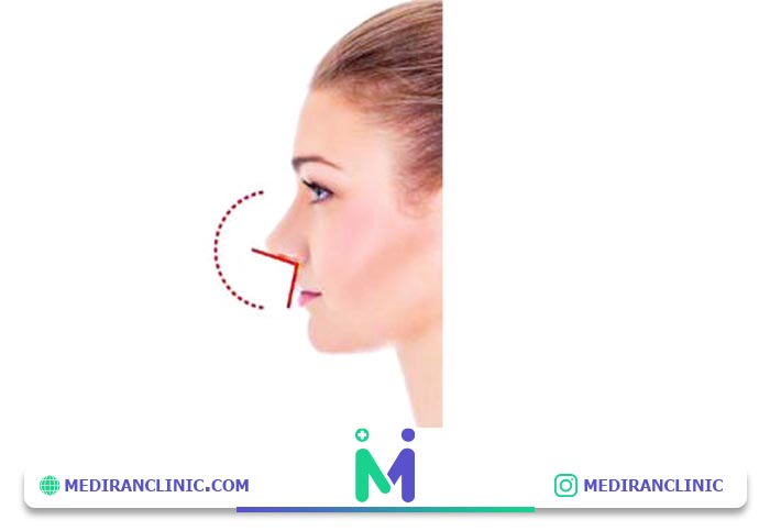 زاویه بین لب و بینی در زیبایی شناسی عمل بینی