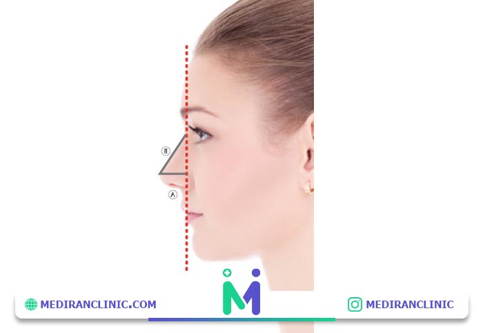 زیبایی شناسی نوک بینی در عمل بینی