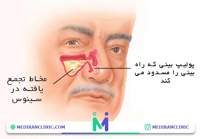 علت ایجاد پولیپ