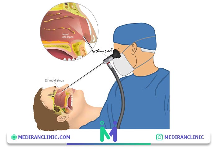 درمان پولیپ با آندوسکوپ