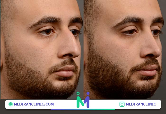 فرم بینی طبیعی مردانه