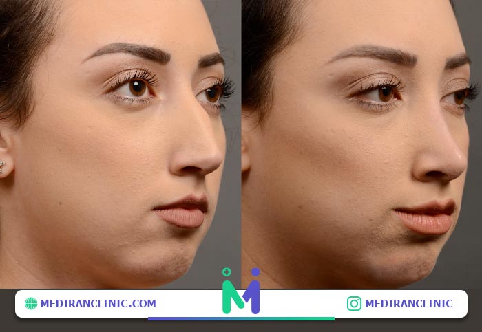 فرم بینی نیمه فانتزی