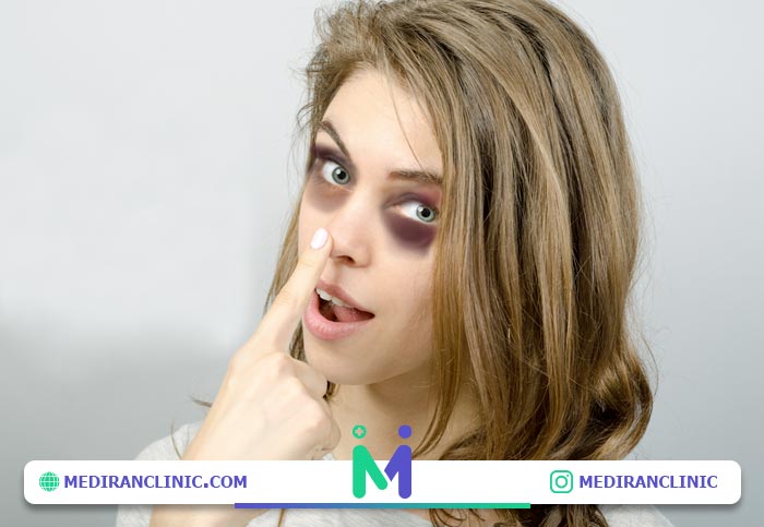 کبودی چشم بعد عمل بینی