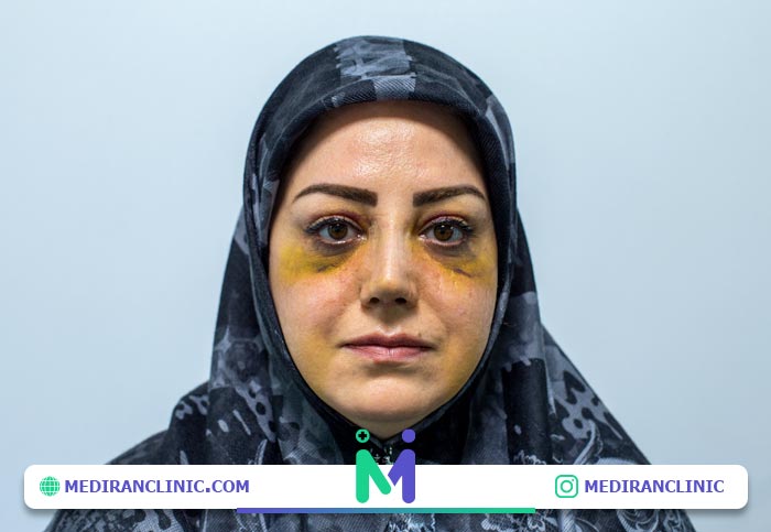 ورم و کبودی بعد عمل بینی