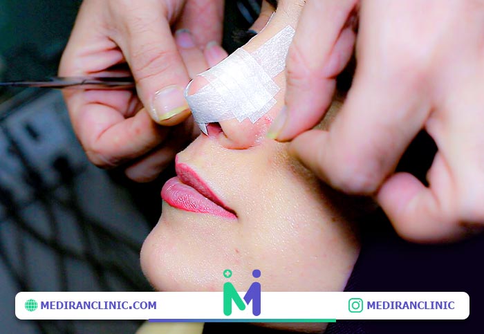 چسب زدن به بینی بعد عمل