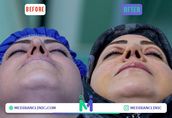 قبل و بعد از سپتوپلاستی