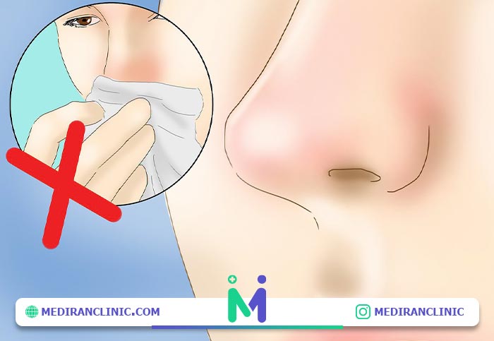 اجتناب از فین کردن بعد عمل بینی