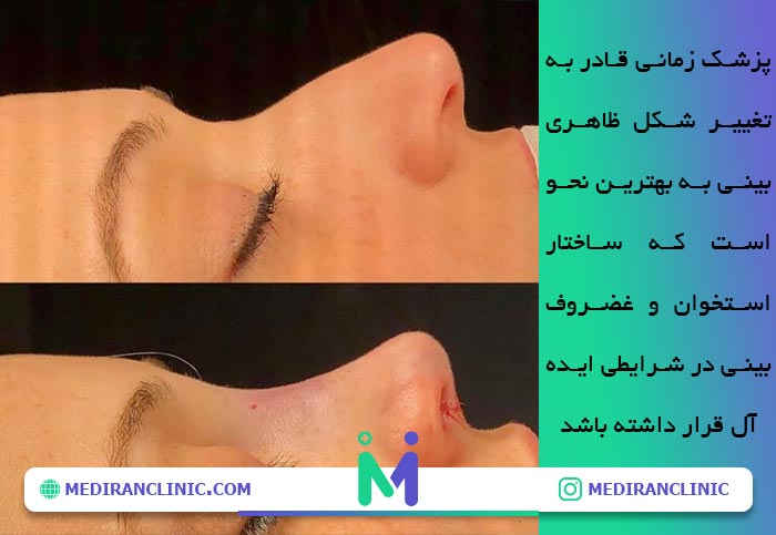 نتیجه رینوپلاستی