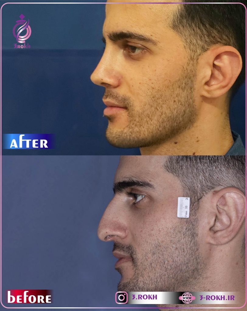 قبل و بعد عمل بینی