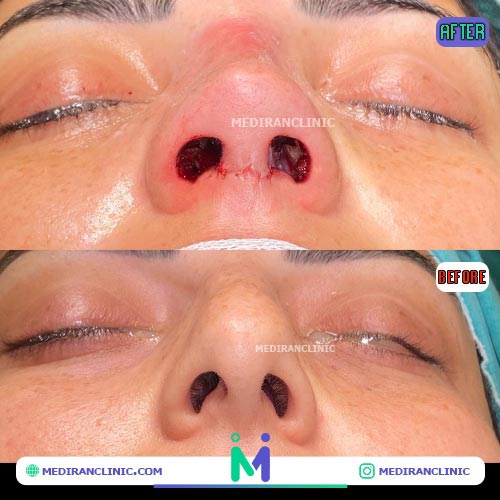 اندازه سوراخ بینی