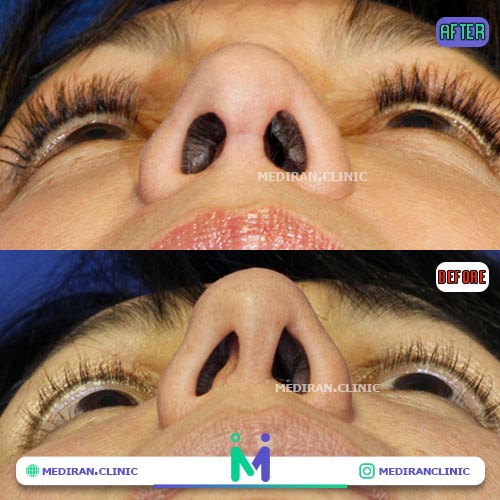 کوچک کردن سوراخ های بینی