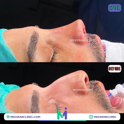 نمونه قبل و بعد رینوپلاستی