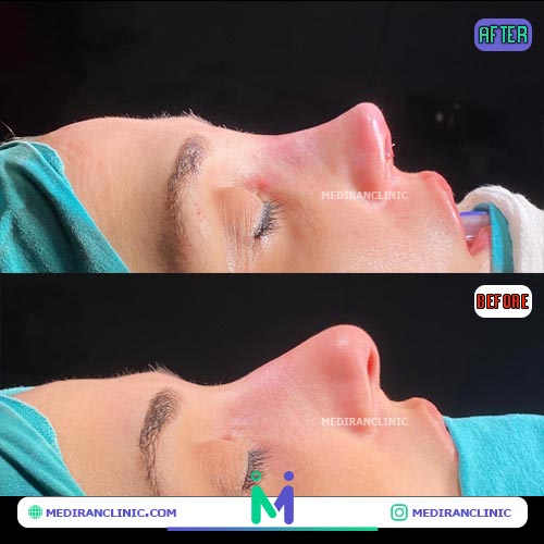 قبل و بعد جراحی بینی