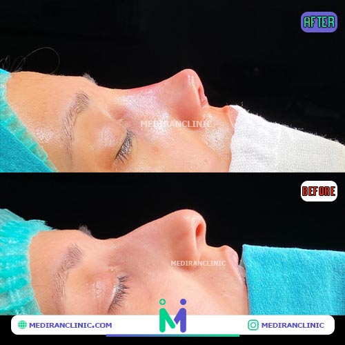 نمونه کار عمل بینی