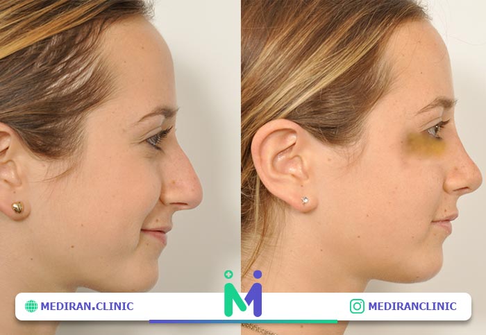 ورم بعد از عمل بینی