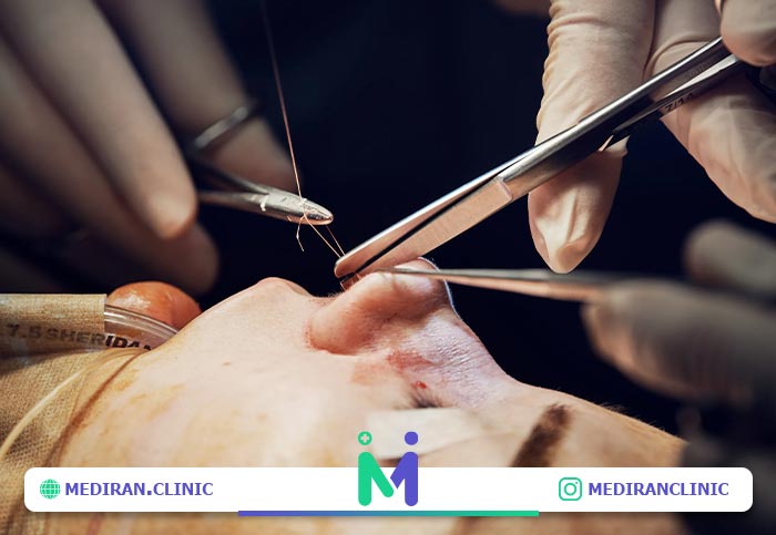 مهارت جراح در کاهش کبودی بعد عمل بینی