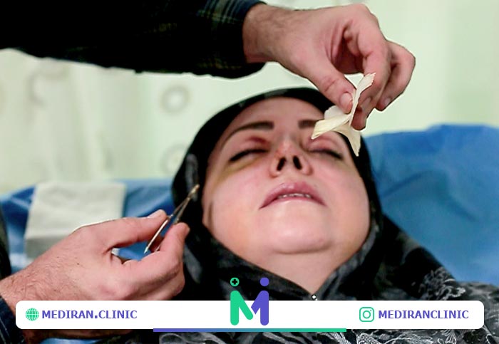 برداشتن اسپلینت بعد ازعمل بینی