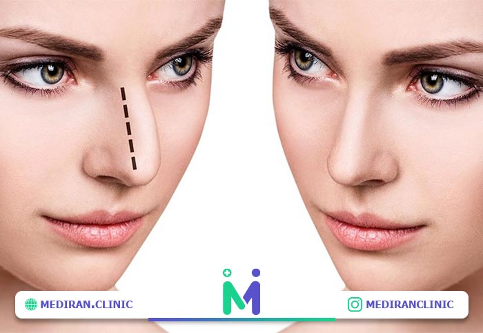 nose surgery03