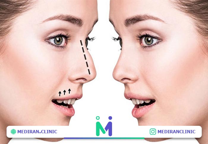 nose seurgery04