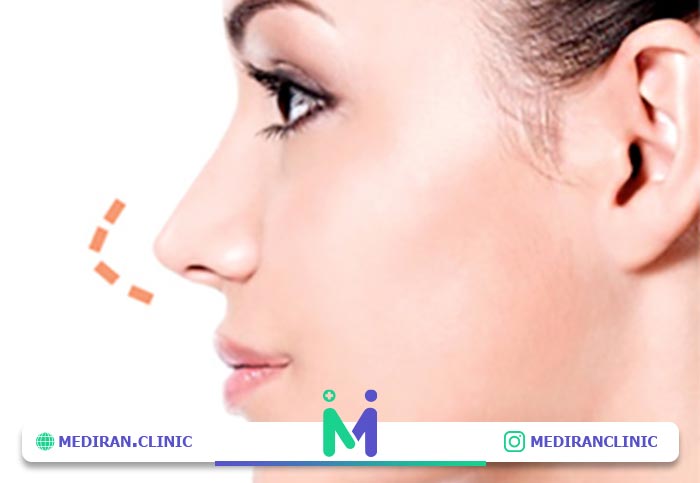 nose surgery01