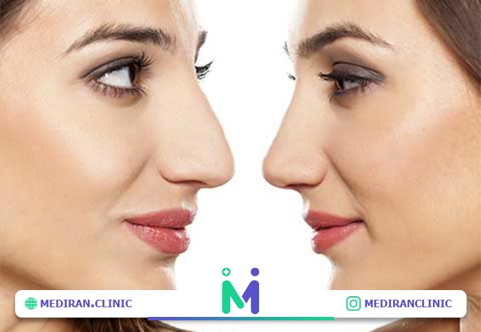 nose surgery02