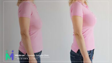 fat grafting and breast prosthesis