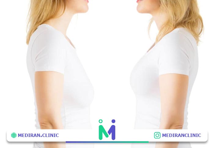 ماستوپکسی یا لیفت سینه