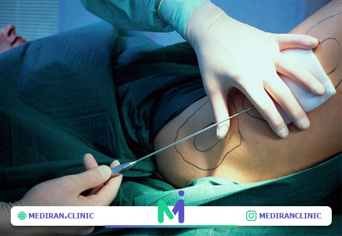 دلیل آمبولی چربی در لیپوماتیک