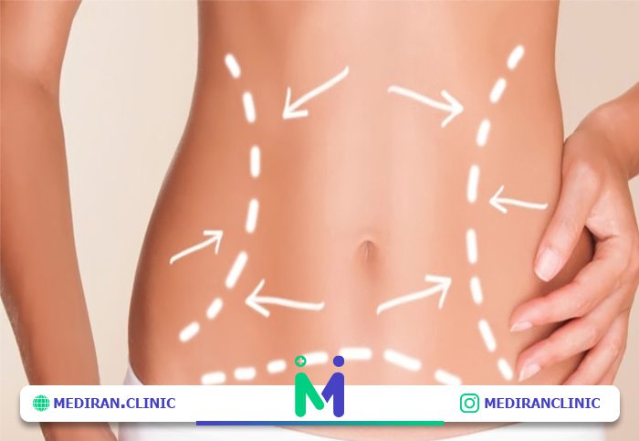 جراحی زیبایی شکم با لیپوماتیک