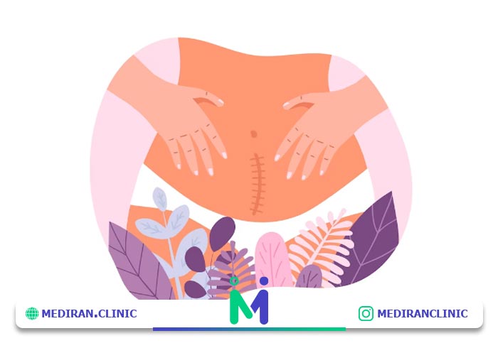لیپوماتیک بهتر است یا ابدومینوپلاستی؟