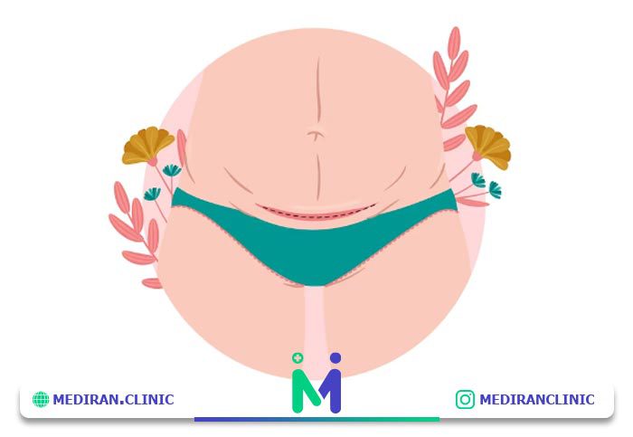 جراحی لیفت شکم