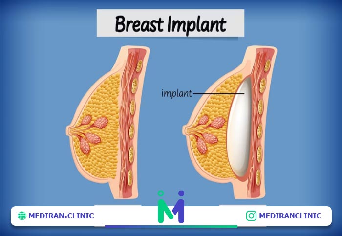 قبل و بعد از پروتز سینه